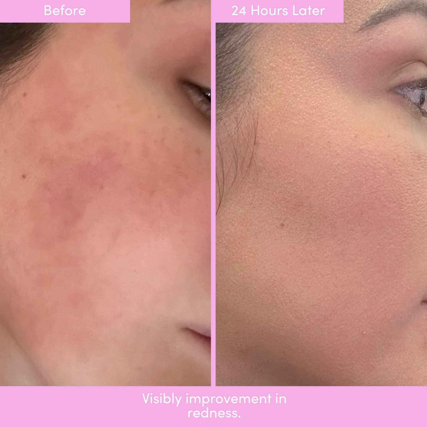 PEP TALK™ Bio-Placenta Barrier Repair Cream for Redness & Dryness